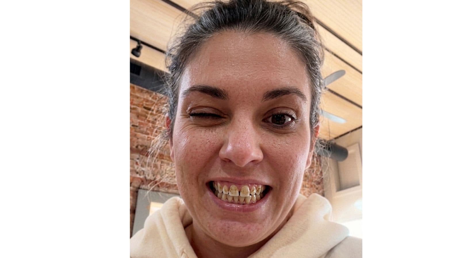 I Haven't Smiled In 3 Years. My Teeth Are Rotten. I Cover My Mouth When I Talk.